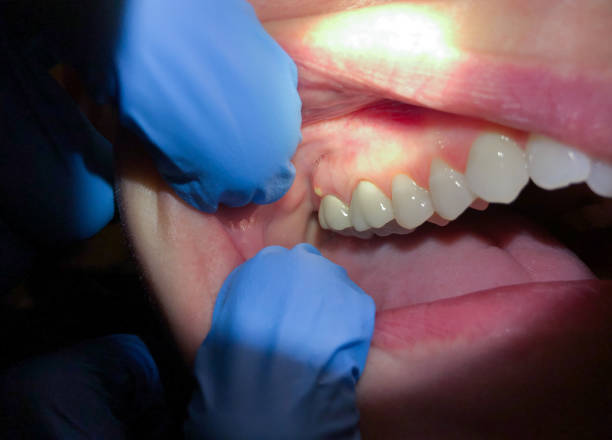 Best Emergency Broken Tooth Repair in Twin Rivers, NJ