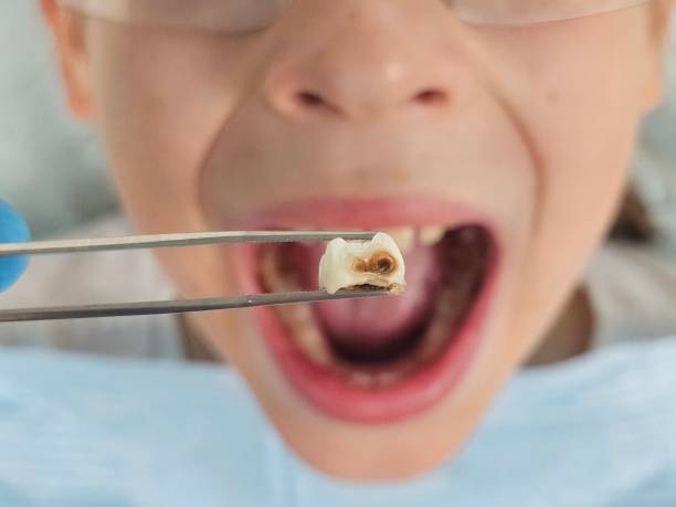Best Emergency Wisdom Teeth Removal in Twin Rivers, NJ